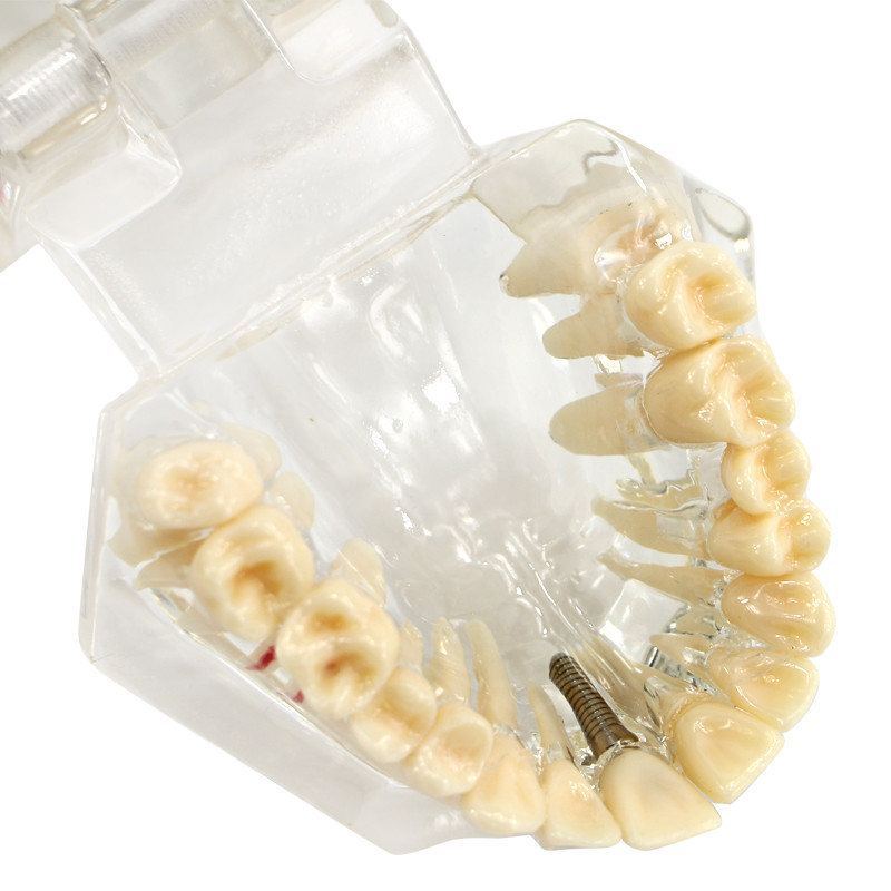 Dental Transparent Pathological Teeth Study Model Implant and Restoration Model