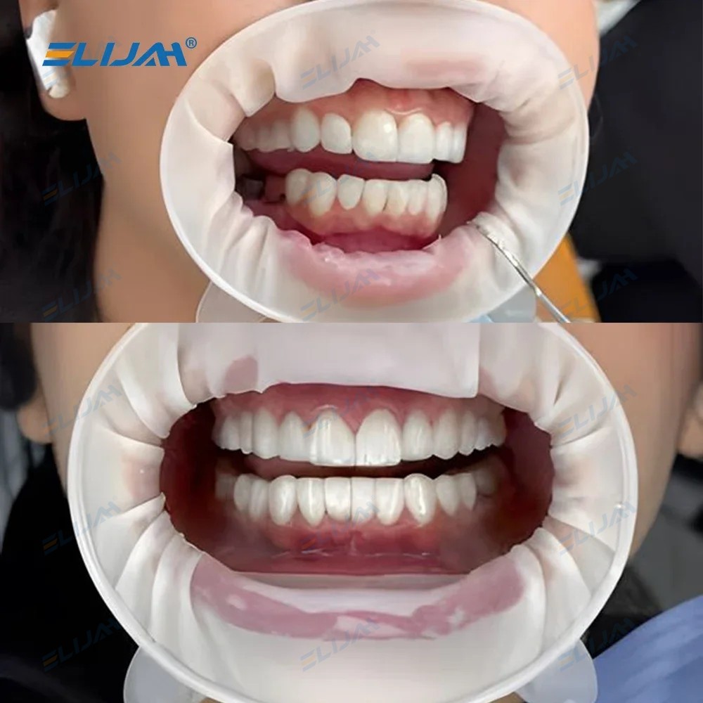 5Pcs Dental Mouth Opener Sterile Rubber Dam Cheek Retractor O Shape Disposable