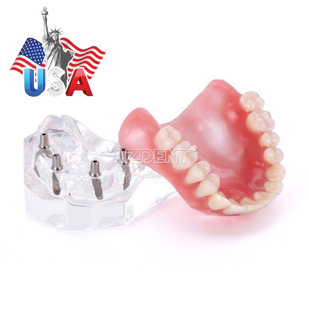 Dental Implant Teach Study Model Demo Overdenture Typodont 4 Implants Upper