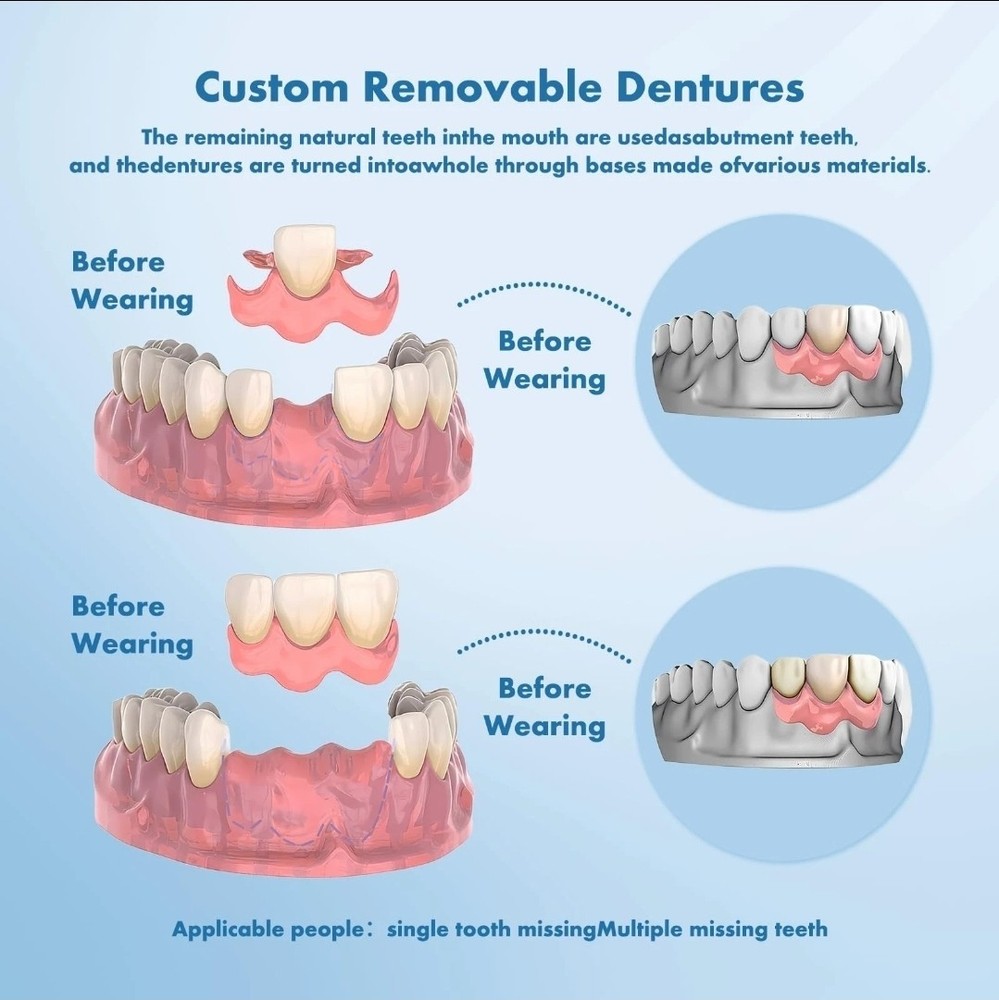 Qiivosm Removable Dentures Personalized Partial Denture Set for Tooth Replaceme