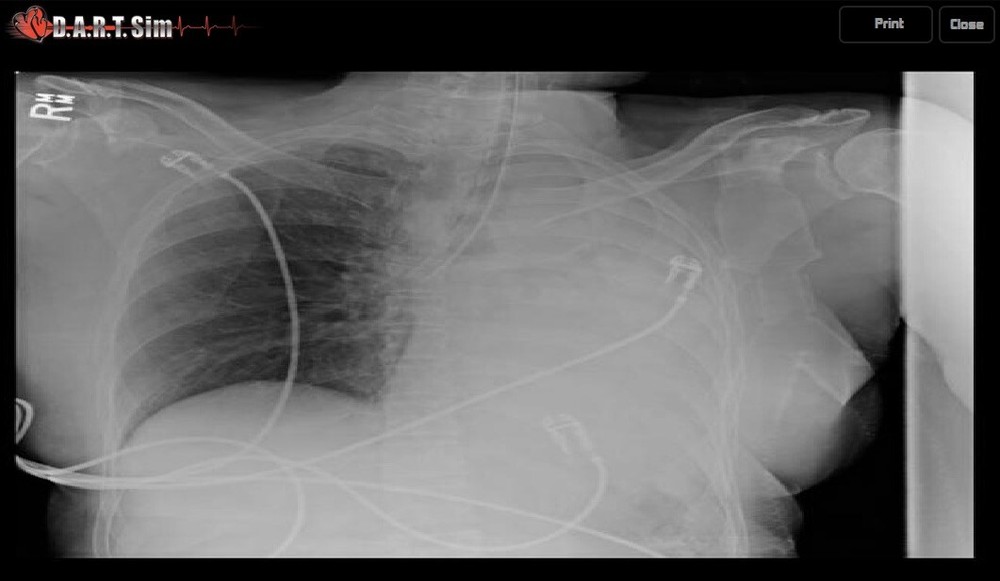 DART Sim Bag Complete ACLS & PALS ECG Simulator/ Defib Simulator Kit