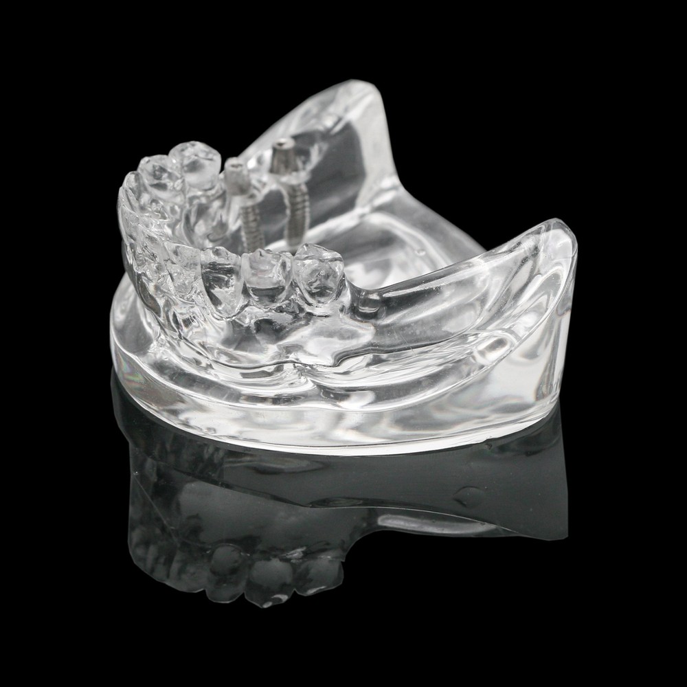 Dental Training Typodont Model with Removable Partial Denture Teaching Model