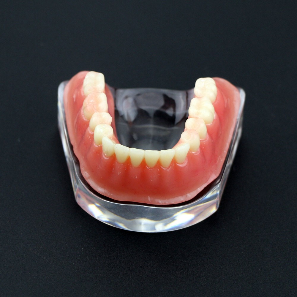 Dental Teeth Model Inferior Overdenture Precision 4 Implants Demo Silver Bar
