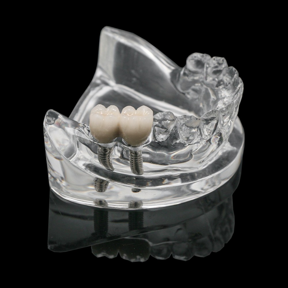 Dental Training Typodont Model with Removable Partial Denture Teaching Model