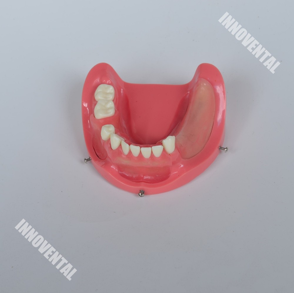 Dental Model #2003 01 - Lower Jaw Implant Practice Model (Replaceable)