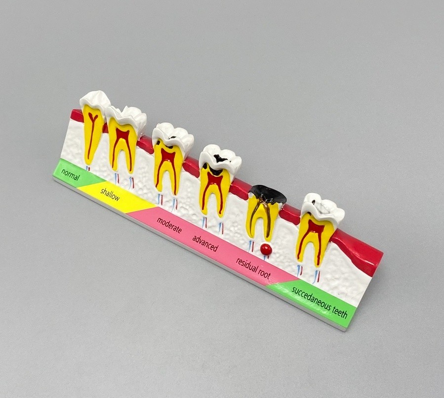 Dental Caries Disease Models Dentoform Typodont Study Teaching Teeth Model Demo