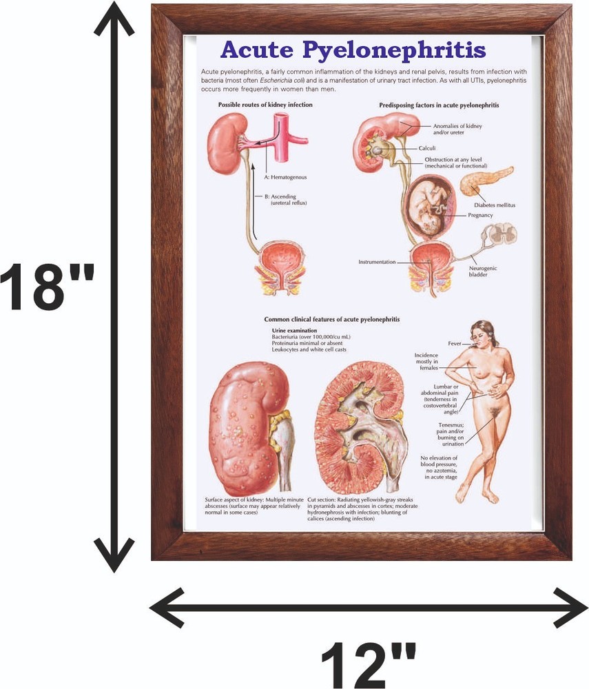 Acute Pyelonephritis Chart 12x18 inches