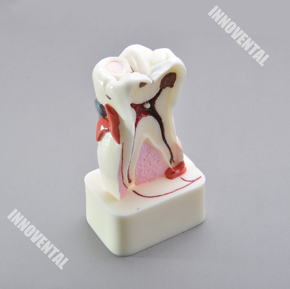 Dental Model #4015 01 -  Pathological Molar Study Model