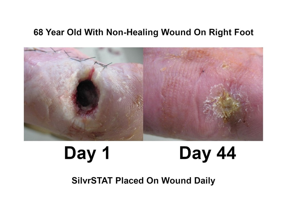 SilvrSTAT First Aid Kit Gel | 32 PPM Silver Healing Wound Dressing Solution |...