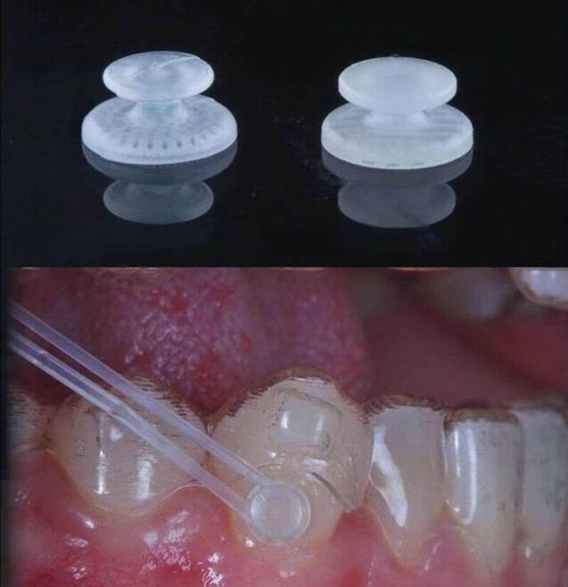 Dental Lingual Button Ceramic Clear Invisable Retainer Aligner  Bondable Round