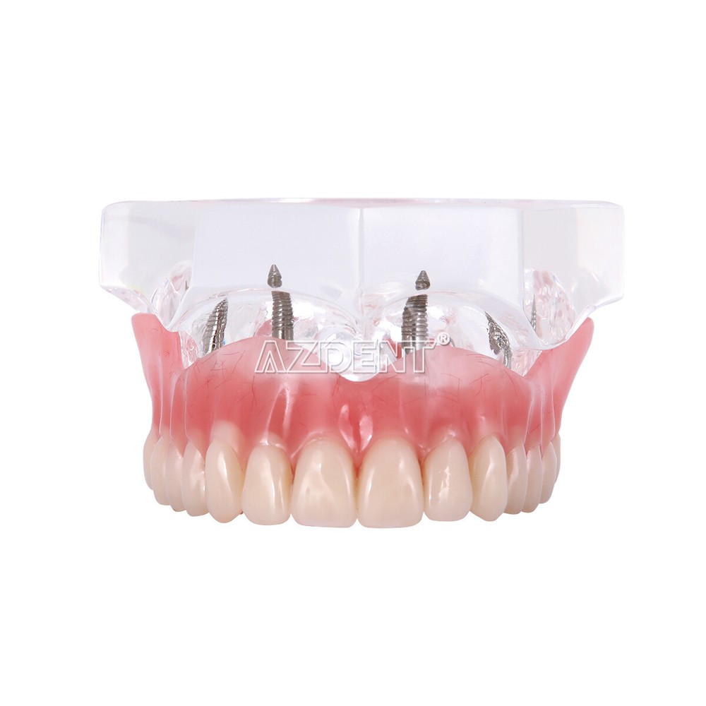 Dental Implant Teach Study Model Demo Overdenture Typodont 4Implants Upper Lower