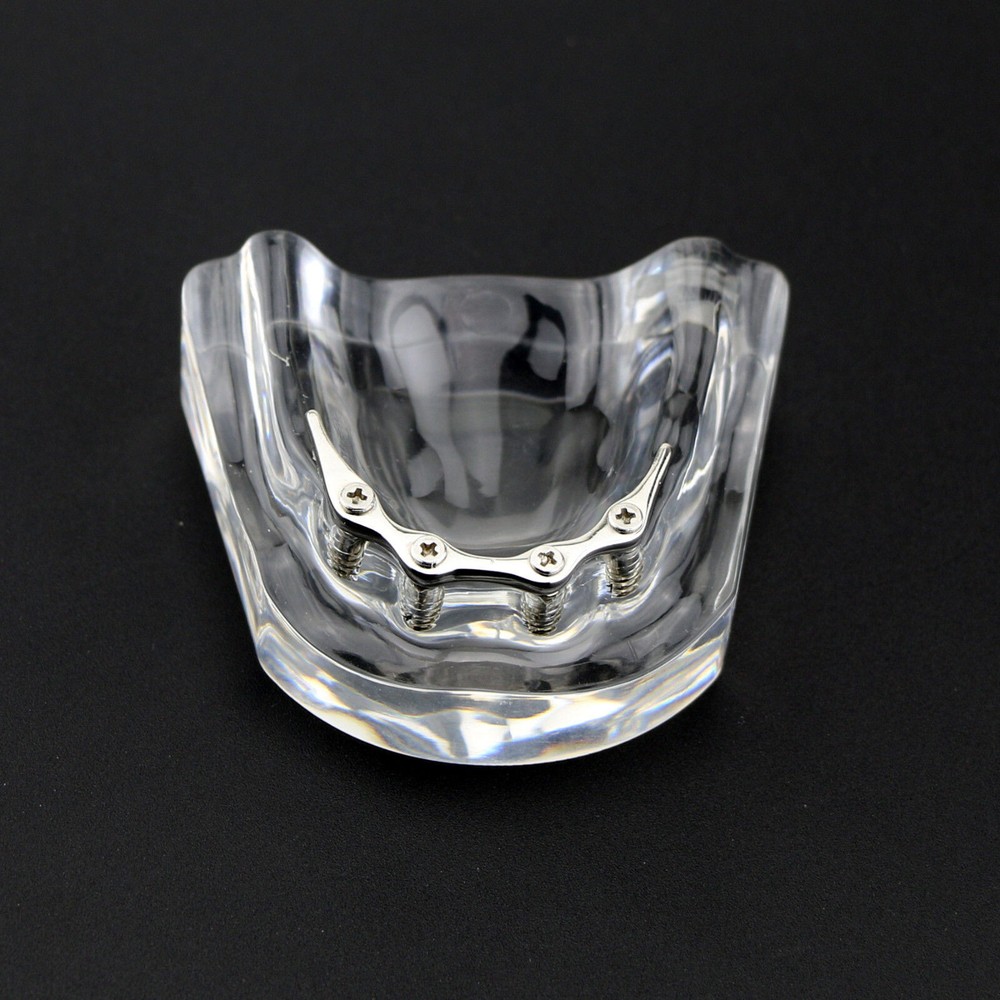 Dental Teeth Model Inferior Overdenture Precision 4 Implants Demo Silver Bar
