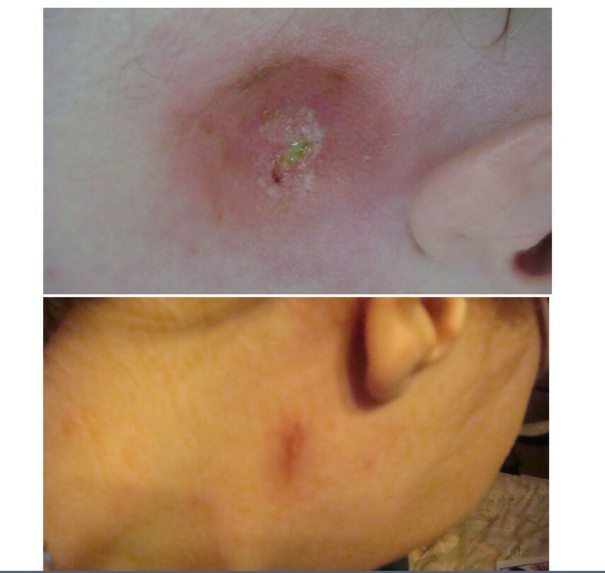 Grandmas Healing Products 1oz- Pine Tar Salve - A Black Drawing Ointment