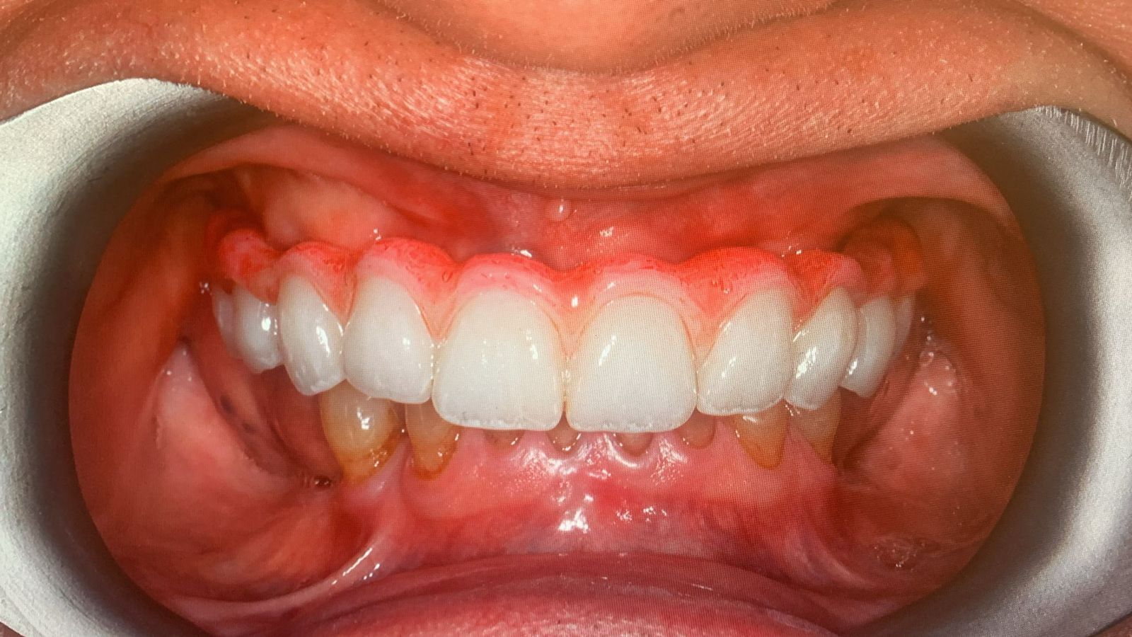 DLP SLA LCD 3d printer ALL ON X resin - for all on x cases, bridges,arcs, hybrid