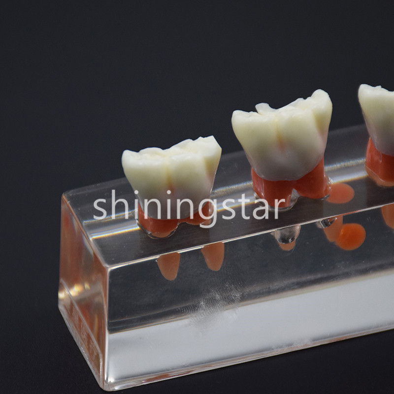 1Pc Dental Teeth Model 4 Stage Endodontic Treatment Demonstrate Study Model 4018