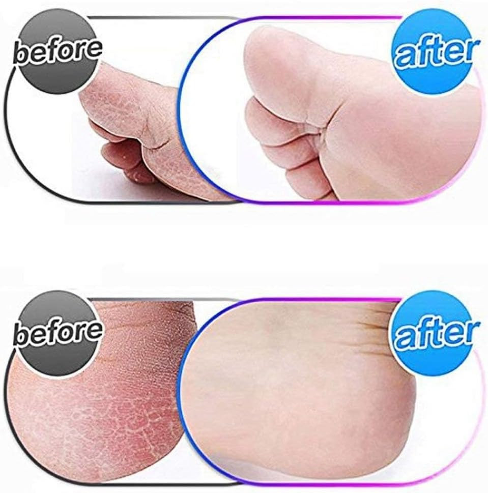 10 Pack Extra Coarse Replacement Rollers for Amope Pedi Refills Electronic Perfe