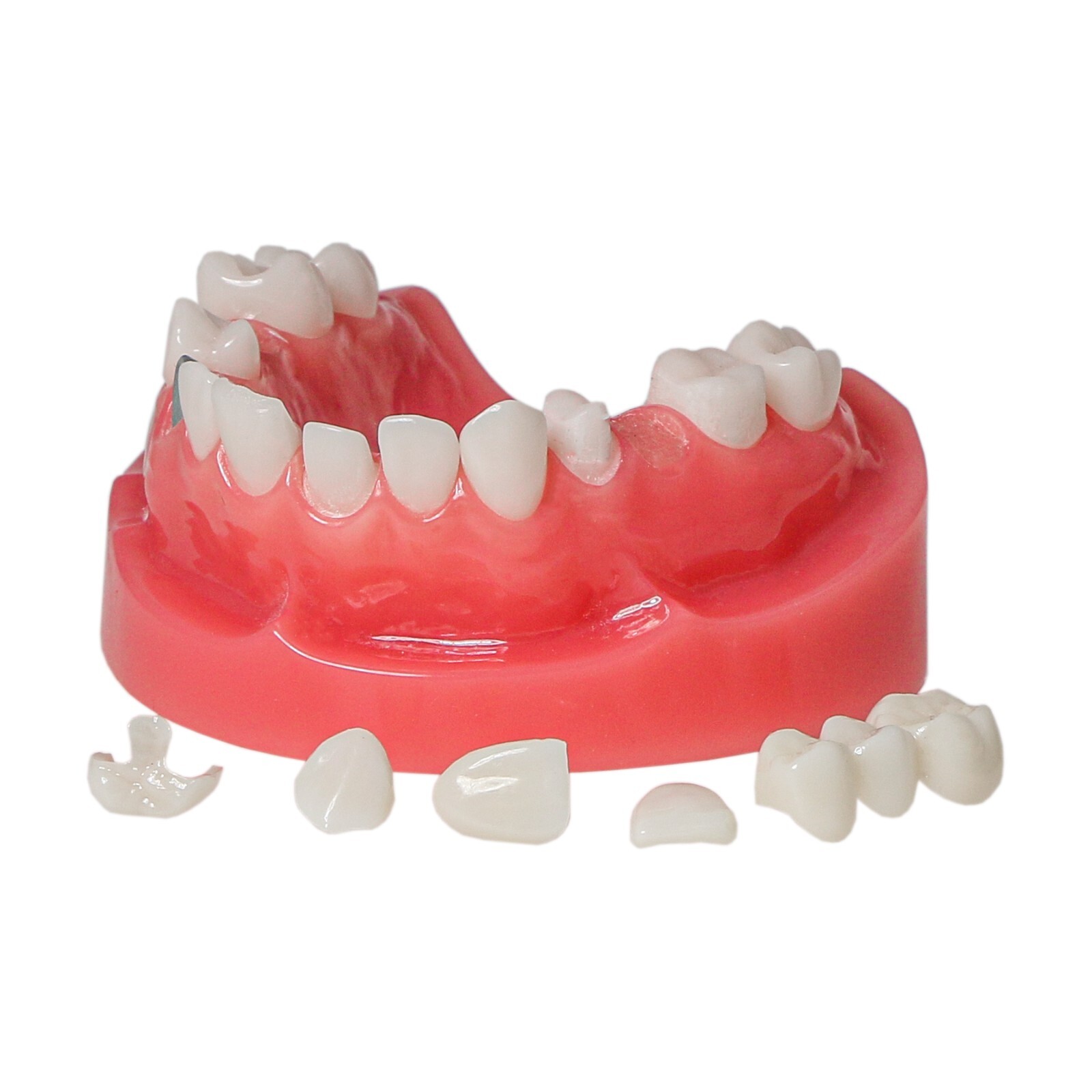 Dental Implant Typodont Teeth Restoration Model Series Overdenture Practice Demo
