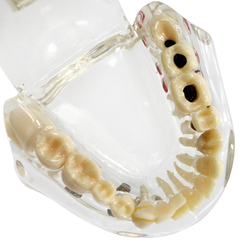 Dental Transparent Pathological Teeth Study Model Implant and Restoration Model