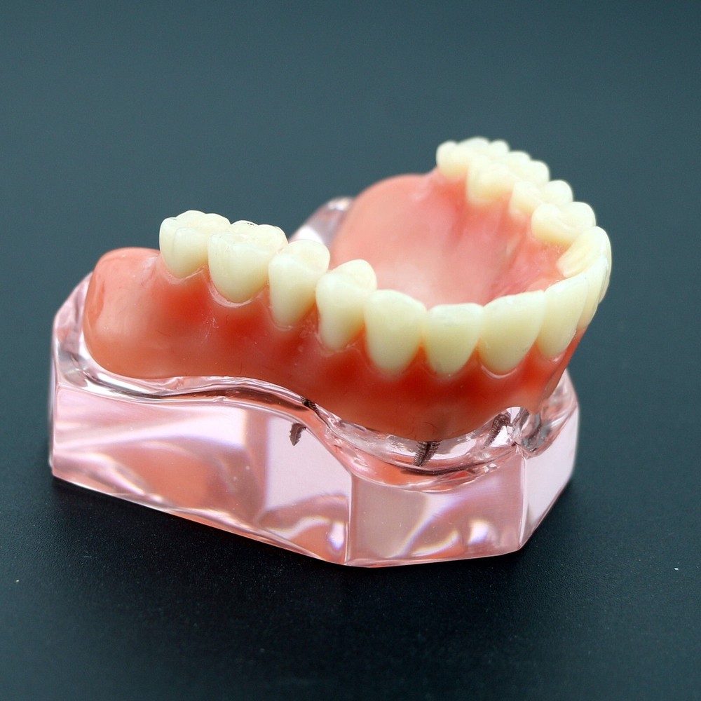 Dental Implant Overdenture Upper Superior Model Precision 4 Maxillary