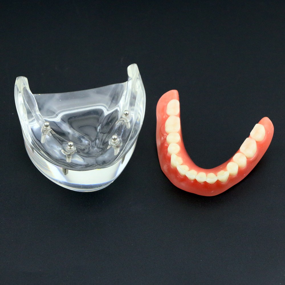 Dental Implants Model Demo Overdenture Typodont Teeth Superior Anatomical model