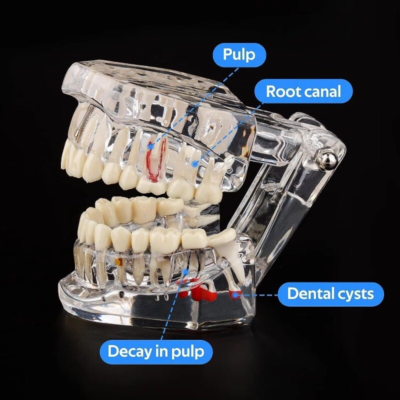Medical Pathological Extrusion Missing Teeth Model Dental Teaching Teeth Model