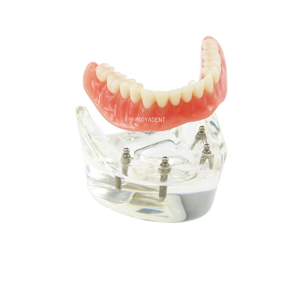 Dental Model 4 Implants superior/Mandibular Removable Overdenture Teeth Model