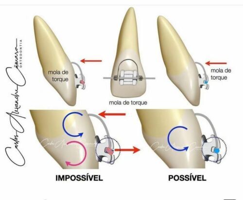 Dental Orthodontic Torquing Torque Spring Rectangular wire Single Anterior Teeth