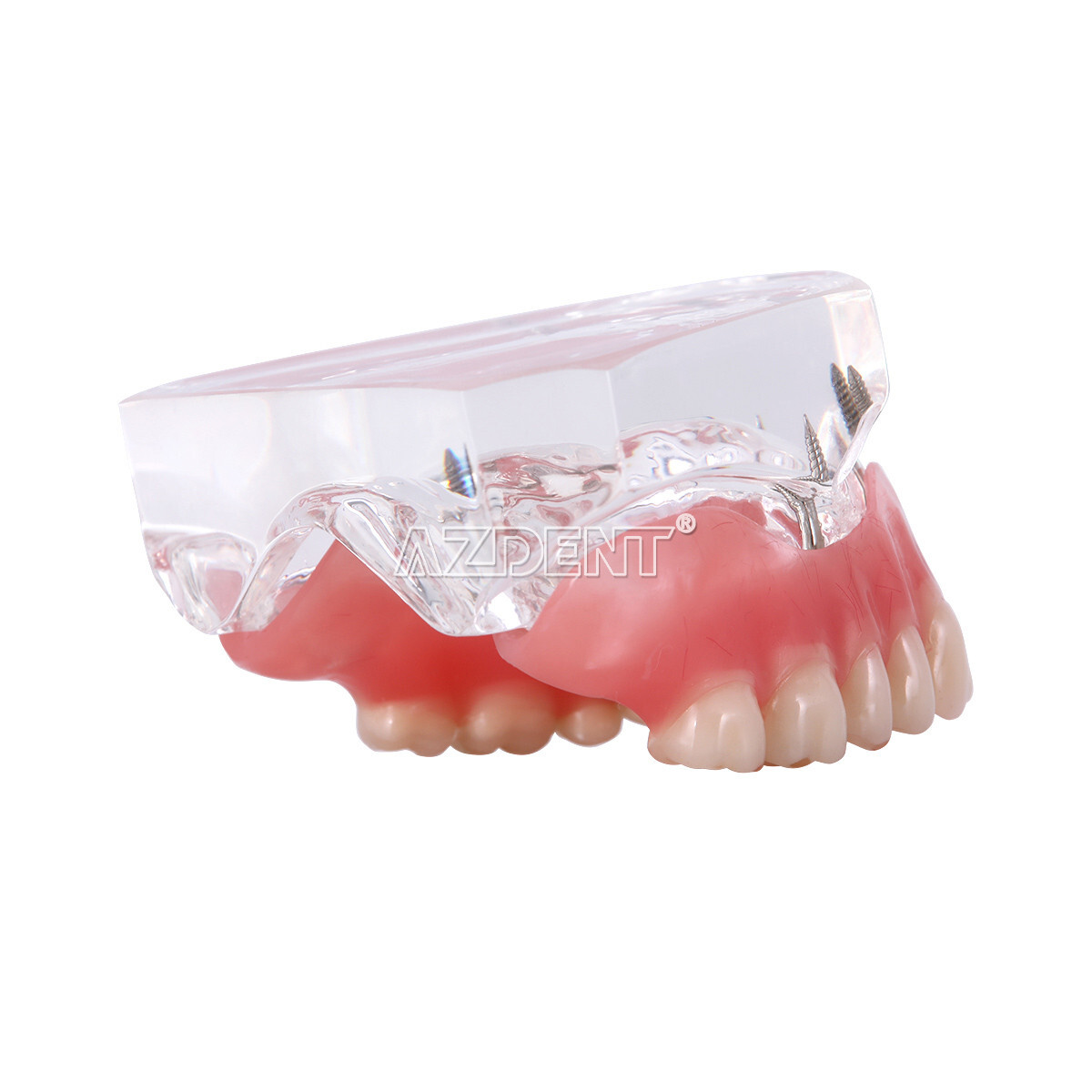 Dental Overdenture Implant Teeth Model Denture with implant Demonstration Clear