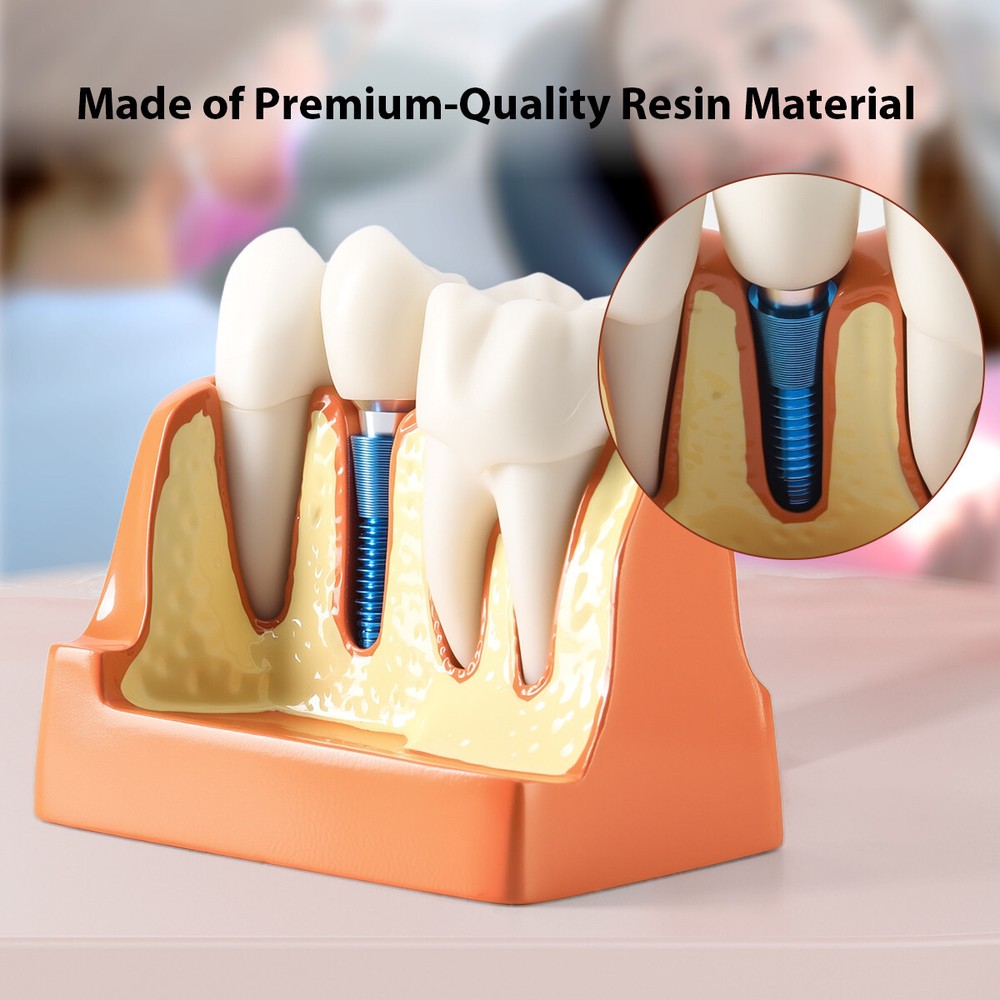 Dental 4Times Teeth Model Implant Analysis Crown Bridge Removable Study Training