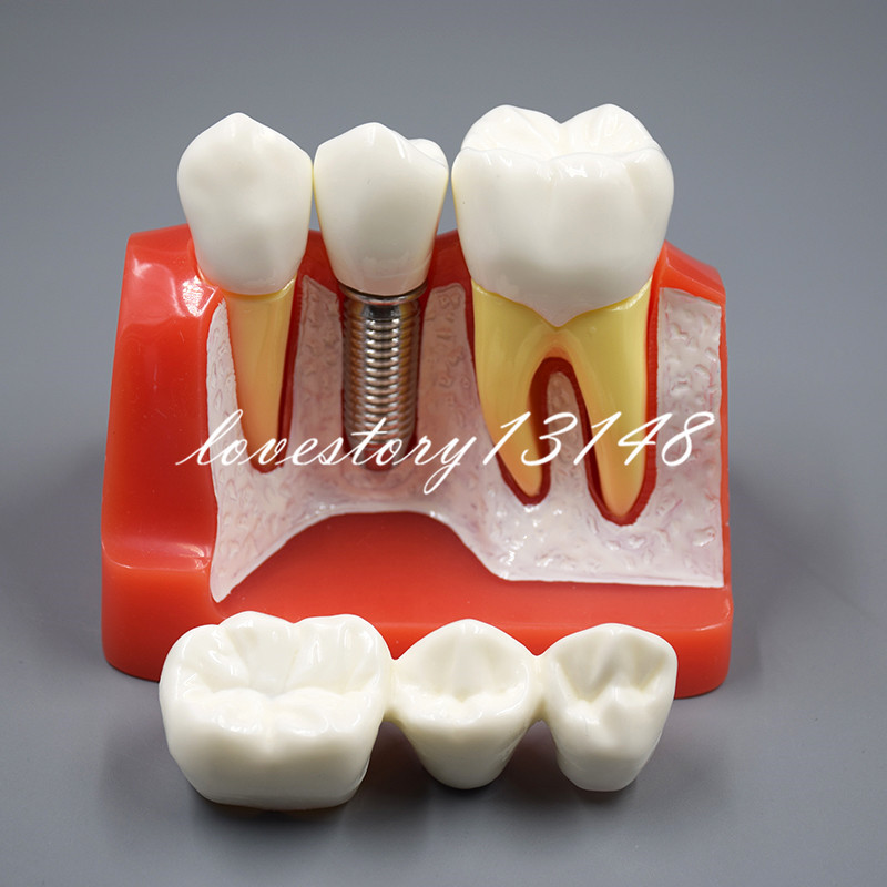 Dental Implant Analysis Crown Bridge Demonstration Teeth Tooth Study Model