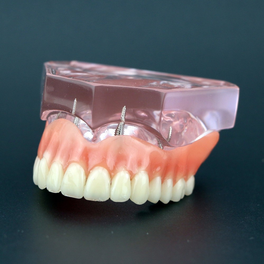 Dental Implant Overdenture Upper Superior Model Precision 4 Maxillary