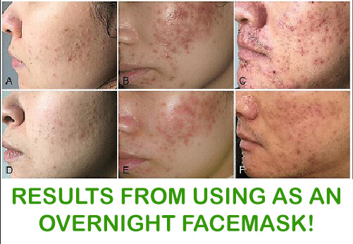 Aloe Vera Gel (THICK) 100% Pure Organic Soothing Moisturizing Skin Lotion BULK