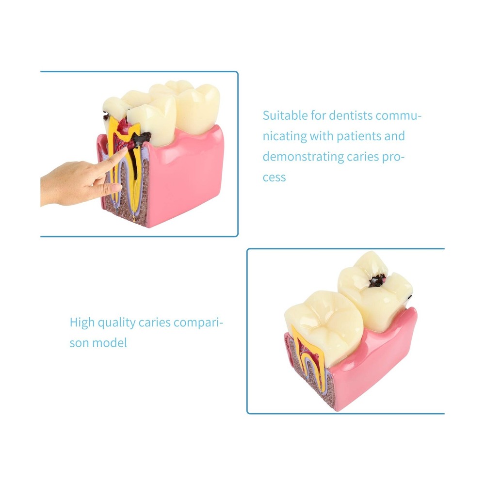 Dental Caries Tooth Model 6 Times Decay Teeth Comparative Study Model, Caries...
