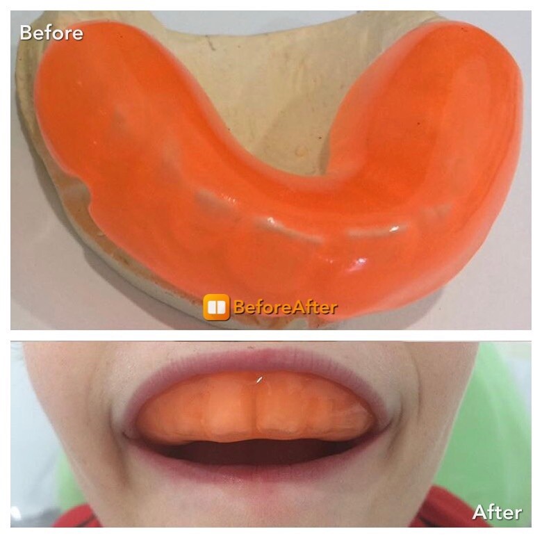 Mouth Guard Custom Made