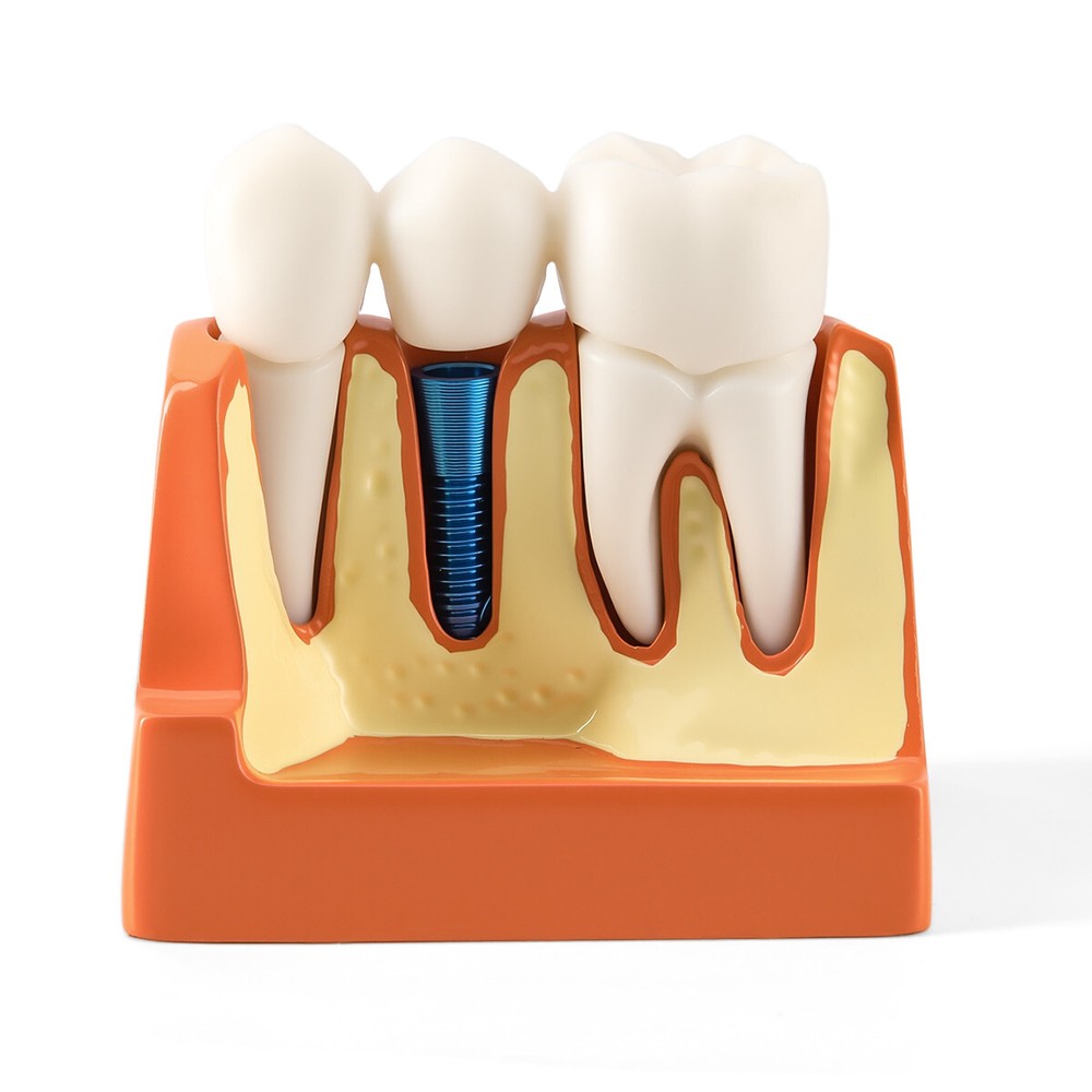 Dental 4Times Teeth Model Implant Analysis Crown Bridge Removable Study Training