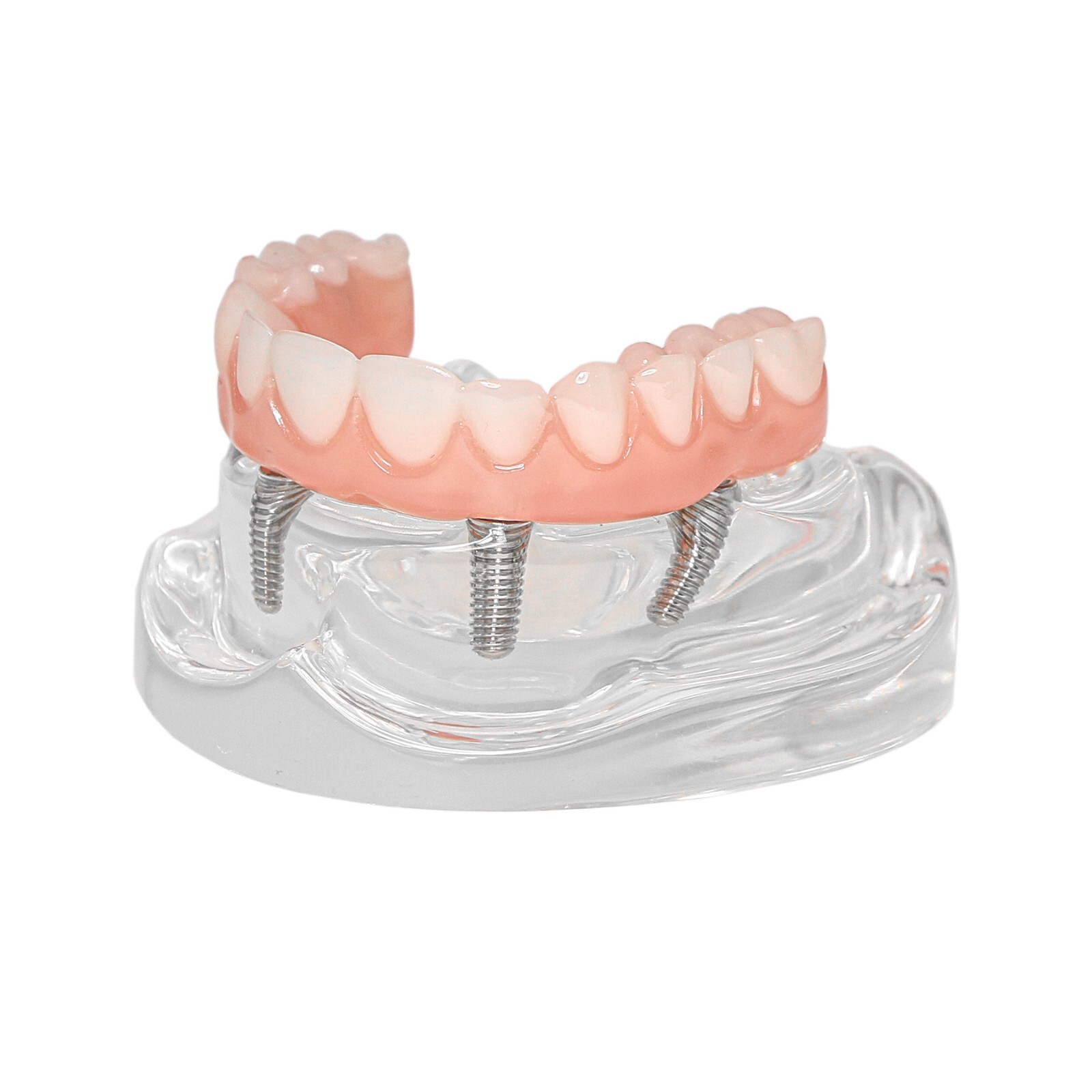 Dental Implant Typodont Teeth Restoration Model Series Overdenture Practice Demo