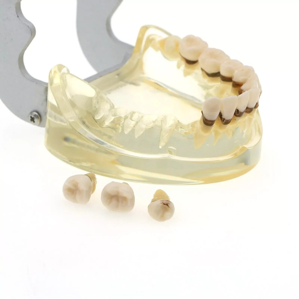 Dental Teeth Model Pathological Disease M4017 Removable Teaching Study Model
