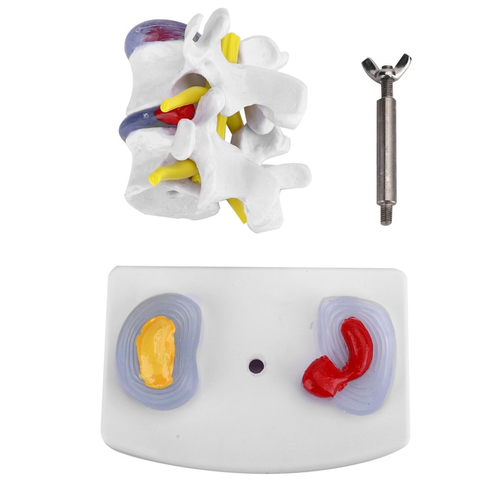 Anatomical Lumbar Disc Herniation Demonstration Model Human Spine School