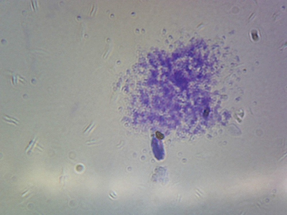 Staphylococcus Aureus; Smear; Gram-Positive