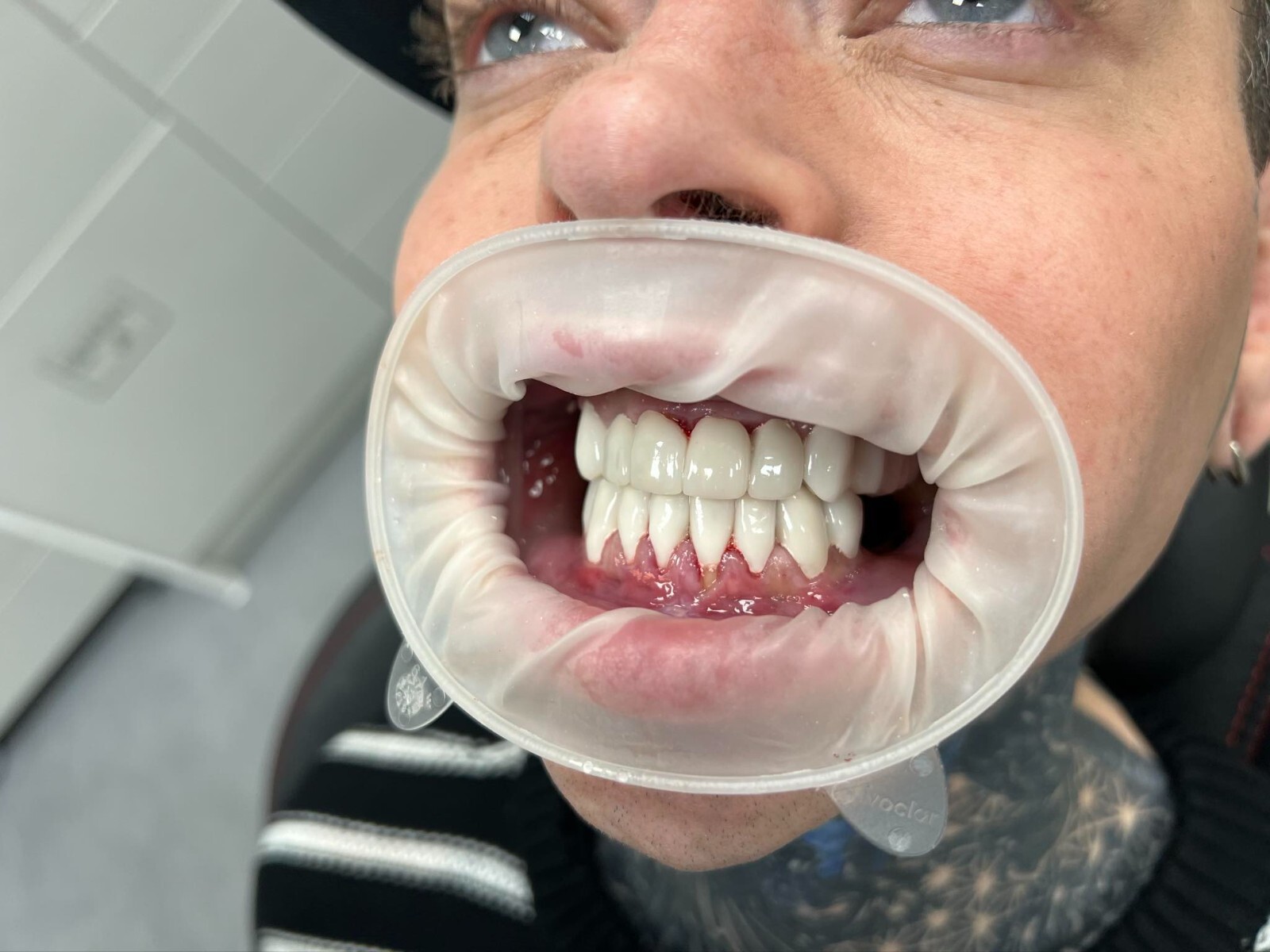 DLP SLA LCD 3d printer ALL ON X resin - for all on x cases, bridges,arcs, hybrid