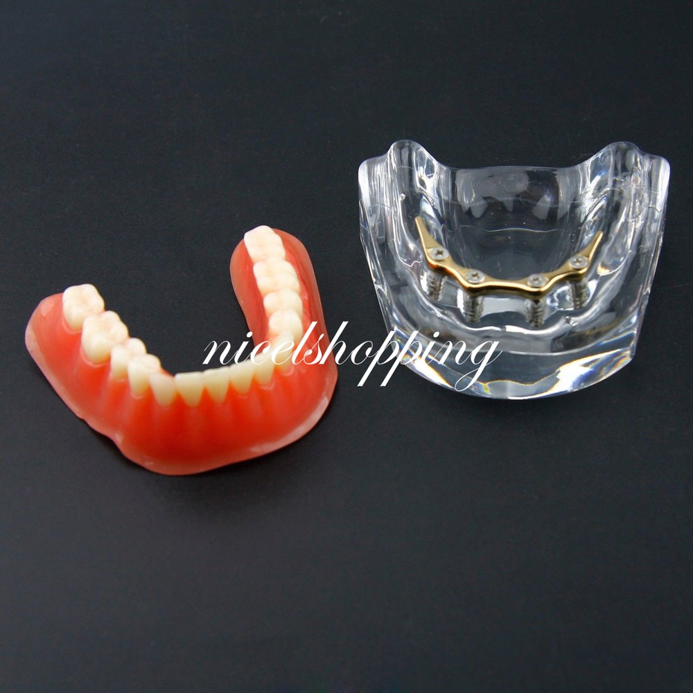 Dental Inferior Overdenture Model Lower Precision Implants With Silver Bar #6009