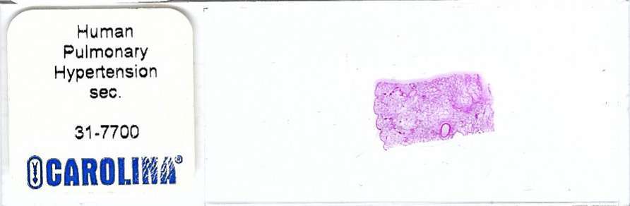 Human Pulmonary Hypertension Pathology Microscope Slide