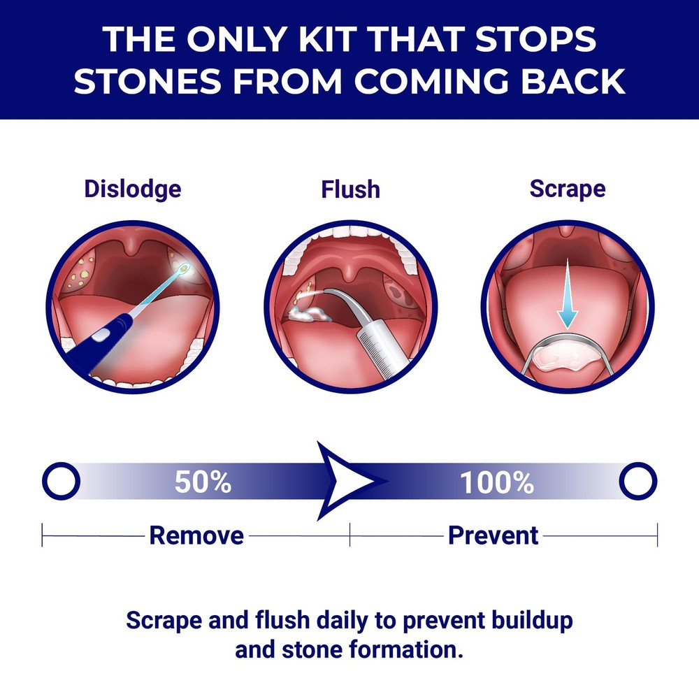 Tonsil Stone Remover - Tonsil Stone Removal Kit - Tonsillolith Remover Tool - To