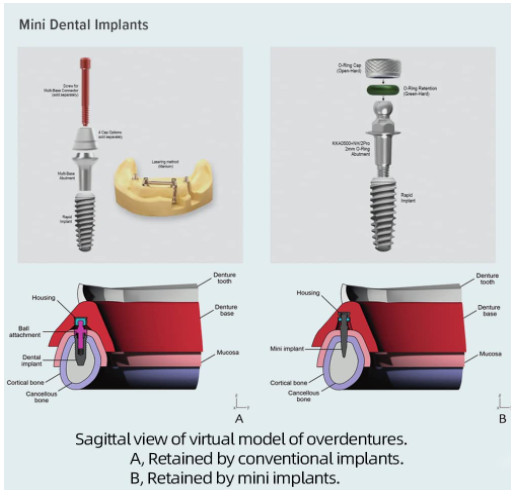 Replacement O-Ring Tool Kit for Mini Dental Implants - 3 Sizes, 36 Total