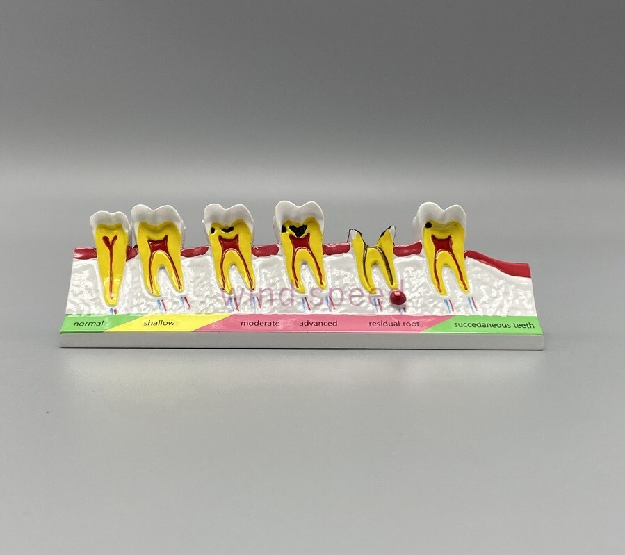 Dental lab Study Teaching Models Caries Disease Assort Teeth Dentoform Model
