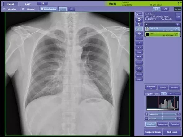 digital mobile wireless radiology machine DR canon portable