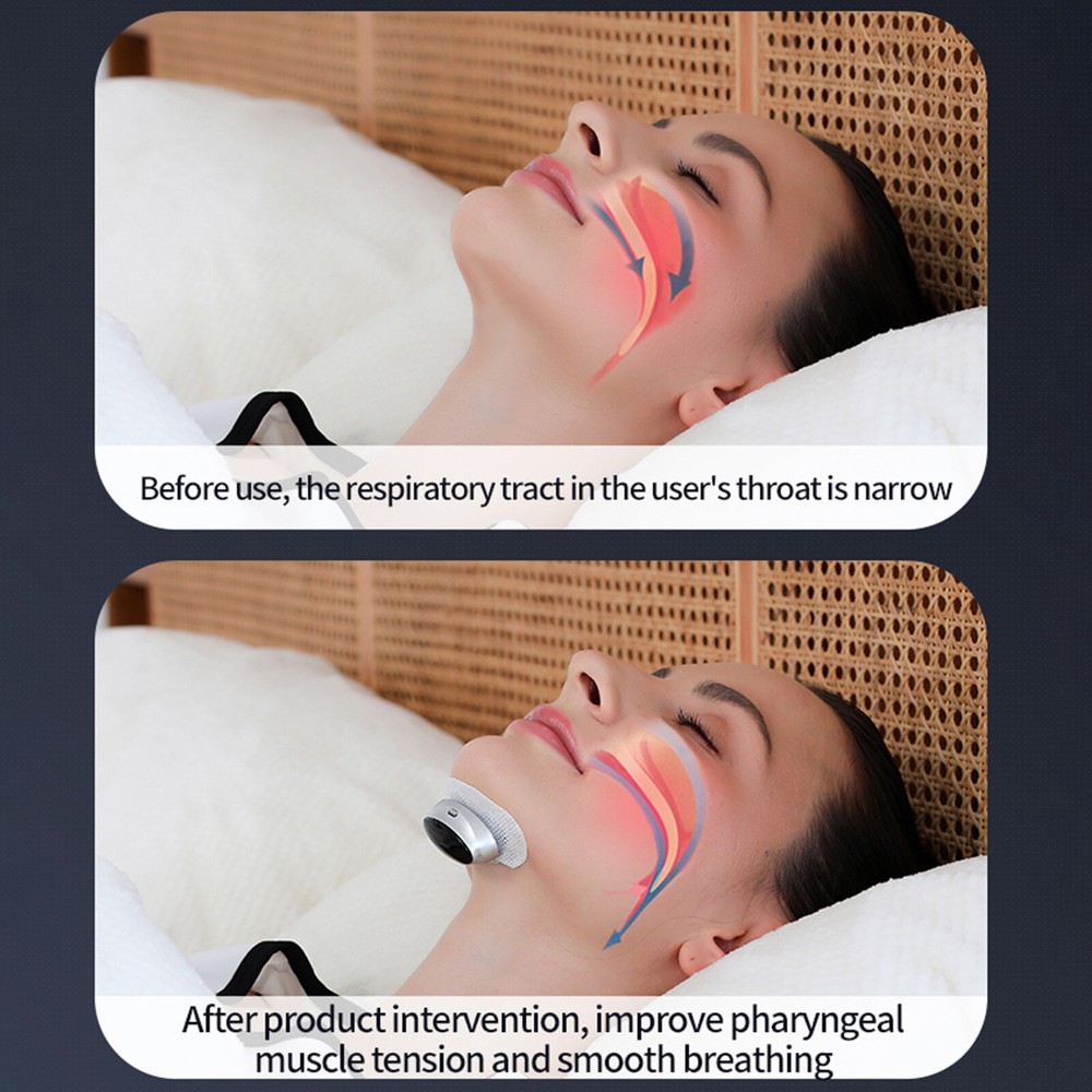 2026 Professional Anti-Snoring Device 3-Speed Adjustment Smart Snoring Solution