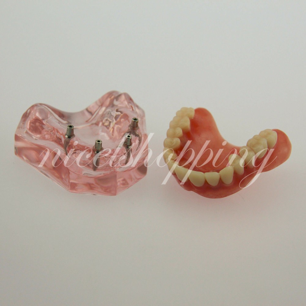 Dental Overdenture Teeth StudyInferior 4 Implant Demo Model Teaching Study