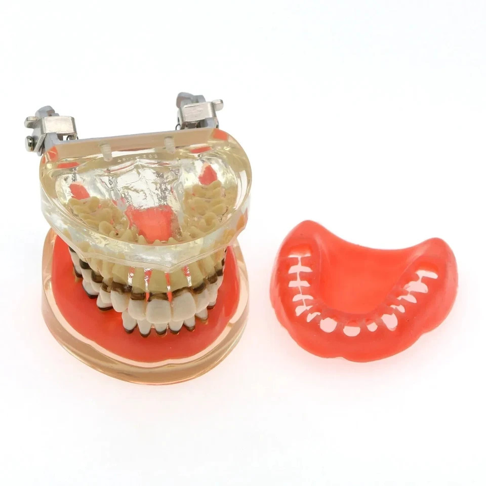 Dental Periodontal Pathological Disease M4017 Removable Teaching Study Model