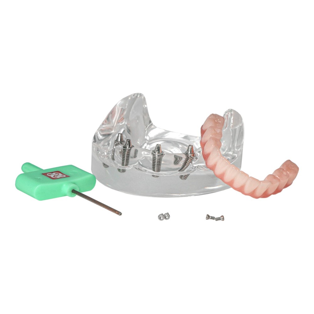 Dental Implant Disease Teeth Model Overdenture Implants Upper/Lower Demo